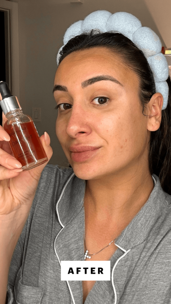 Trakoshis 9 hours after using the TanLuxe The Face Illuminating SelfTan Drops